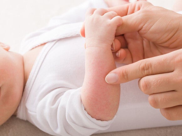 parent pointing at a rash on baby who is wearing white bodysuit arm 